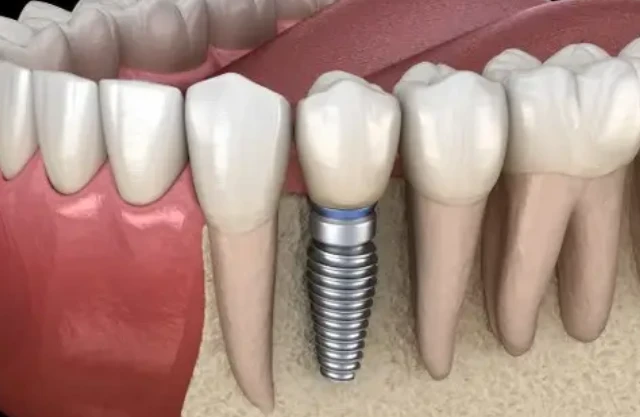 choose abutment-manners choose abutment-manners
