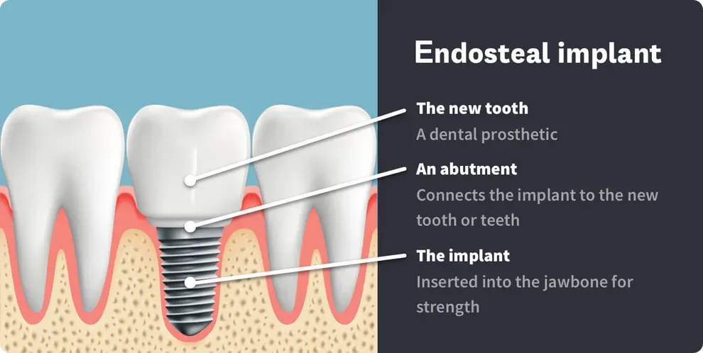 Endosteal Implants Endosteal Implants