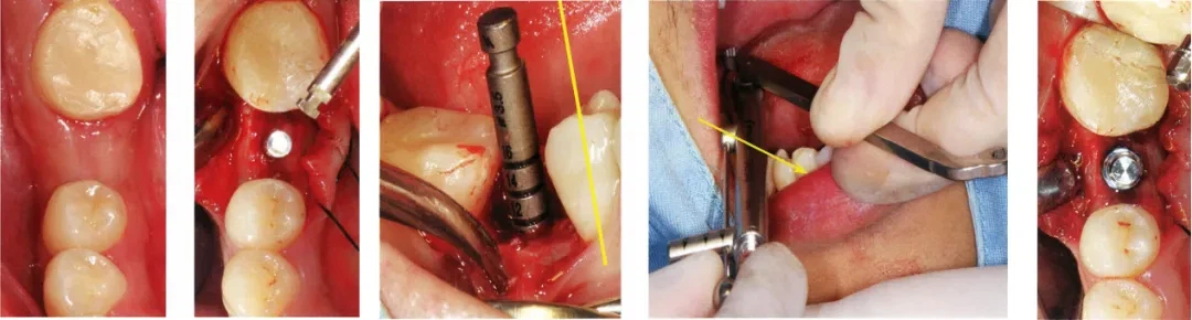 the bone cavity to correct the axis with external force the bone cavity to correct the axis with external force