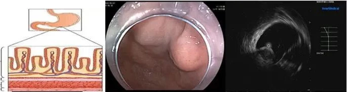 Stomach Wall Structure, Gastric Fundus Elevation, Muscularis Propria Stomach Wall Structure, Gastric Fundus Elevation, Muscularis Propria
