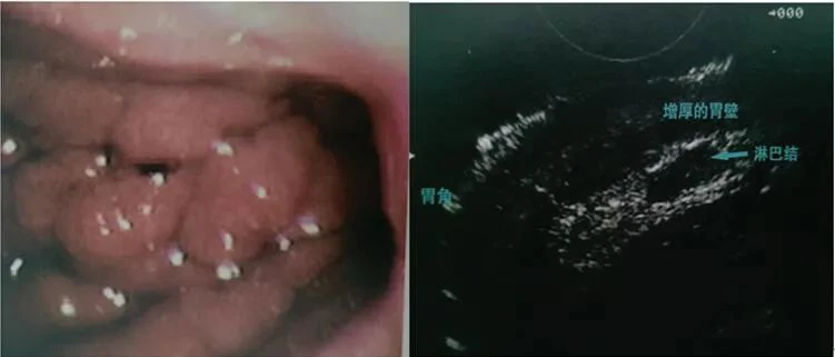 Gastric Lymphoma, Ultrasound Image of Gastric Lymphoma Gastric Lymphoma, Ultrasound Image of Gastric Lymphoma