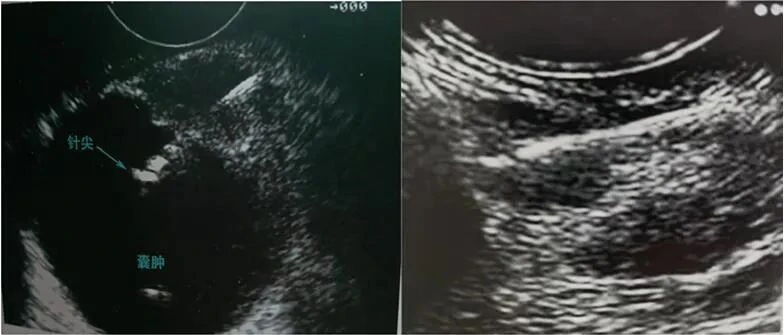 Pancreatic Head Cyst EUS-FNA, Mediastinal Lymph Node EUS-FNA Pancreatic Head Cyst EUS-FNA, Mediastinal Lymph Node EUS-FNA
