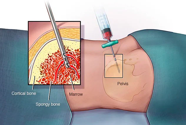 Illustration showing a doctor performing a bone marrow biopsy, inserting a needle into the pelvic bone Illustration showing a doctor performing a bone marrow biopsy, inserting a needle into the pelvic bone