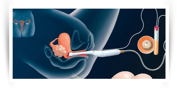 IVF egg retrieval procedure shown with ultrasound guidance and egg collection needle. IVF egg retrieval procedure shown with ultrasound guidance and egg collection needle.